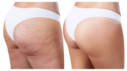 ENDERMOLOGIE-Cellulite-W1TanningandBeauty-Treatments-770x434-1