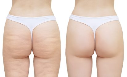 Cellulite on the buttocks and thighs. White isolate. Before and after